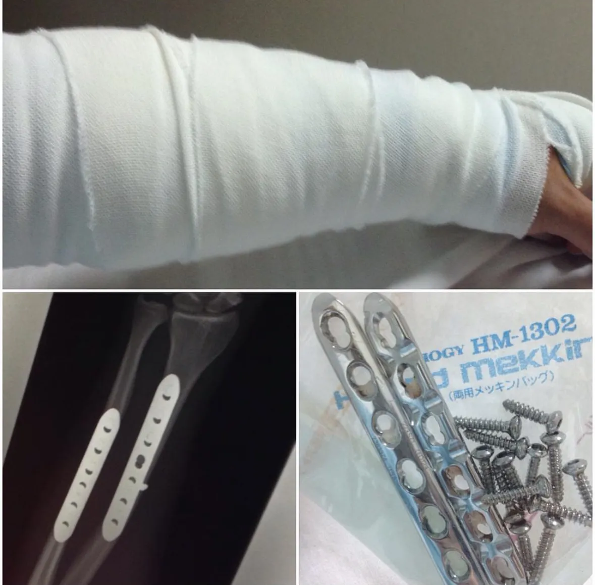 A cast, an X-ray of the plates in my left forearm, and the actual plates and screws that were inside my arm