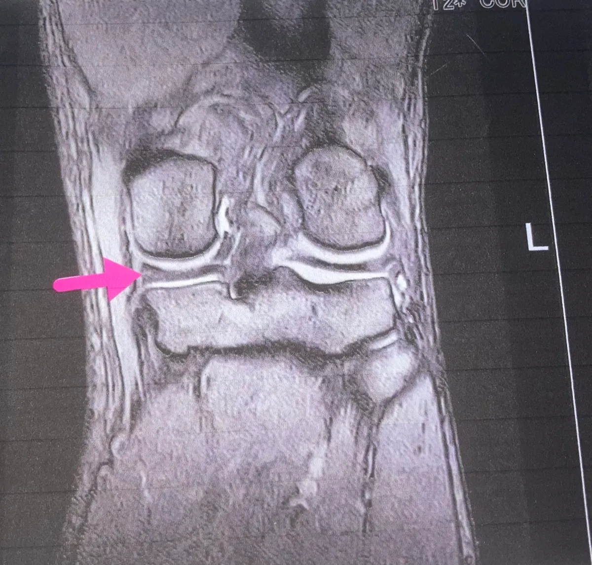 MRI of my knee (meniscus)